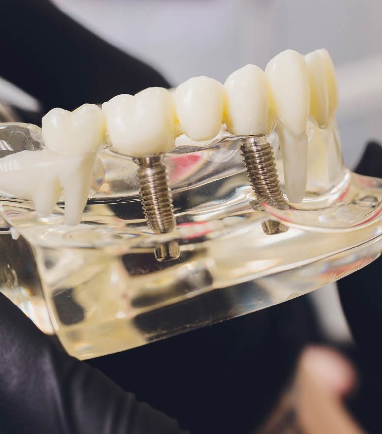 Implant steps in Dumfries