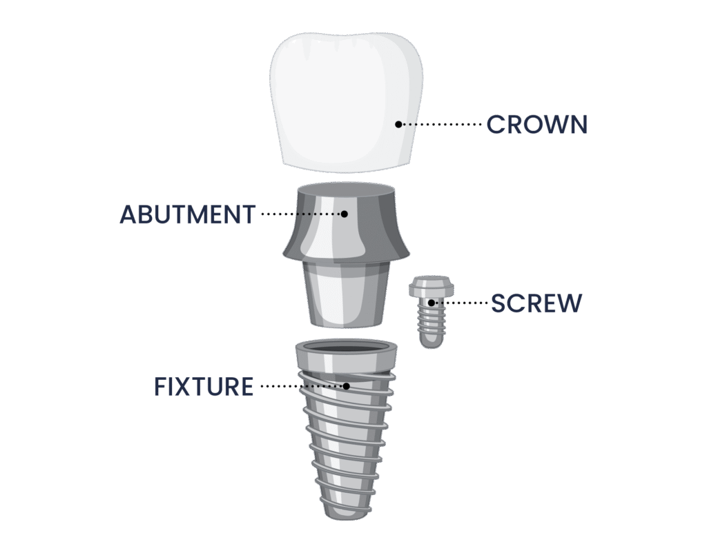 Understanding Dental Implants in Dumfries