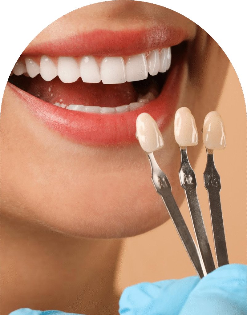 Veneers Treatment in Dumfries